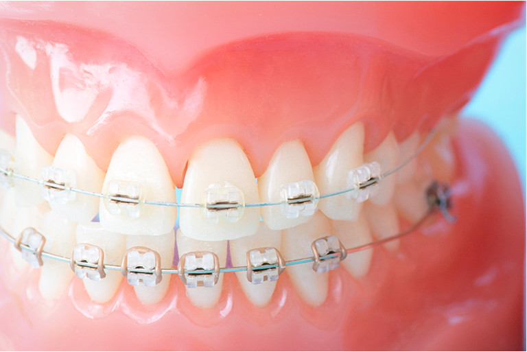 歯周病と矯正治療の関係